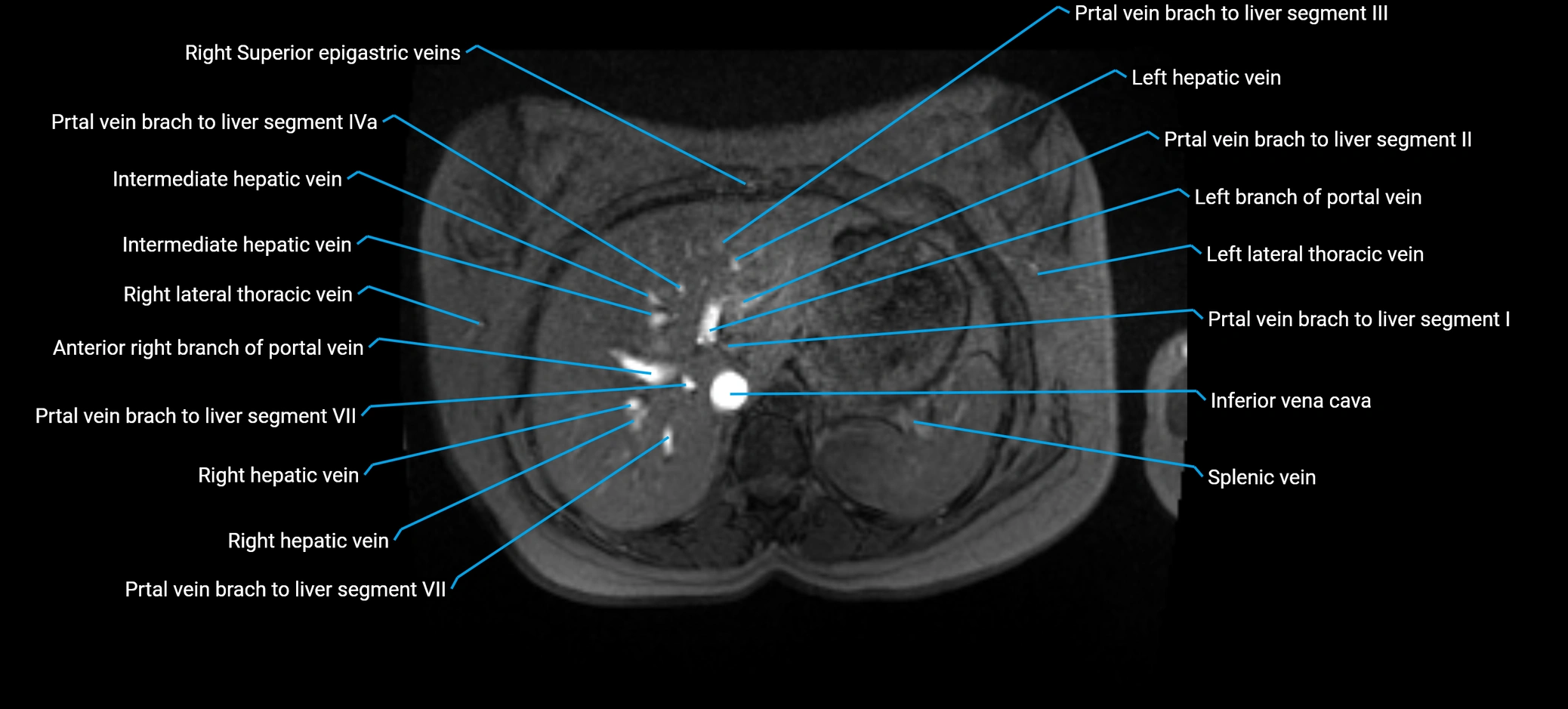 MRV abdomen pelvis & lower limb axial cross sectional anatomy labelled MRI image 35 (1).webp